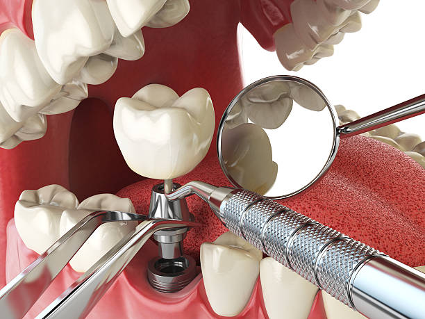 Emergency Dental Filling Replacement in GA